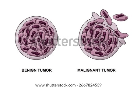 Vector illustrations of malignant and benign tumors in body tissues. Spread of cancer cells. Medical vector illustrations for education, posters, clinics, and science.