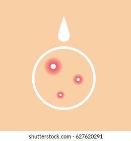 Vector image of an acne treatment cream. The minimalist form.
