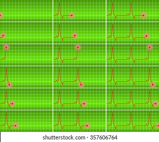 vector image - cardiograms set on a green background