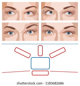 Vector image of the elements for an ophthalmic test, to determine the hypermetropia of the eyes. On a white background 4 faces, with a different position of the eyes, as well as other elements.