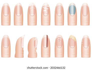 Vector image of fingers with damaged nails. A set of nails with different diseases. Defective nails.