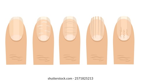 Vector image of fingers with damaged nails. A set of nails with different diseases. Defective nails. Common nail disorders and diseases.