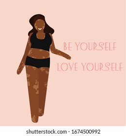 Vector image of a girl with vitiligo. The picture expresses love for your body, self-confidence and acceptance of your shortcomings