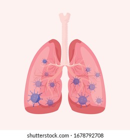 
Vector image of the lungs in which the virus. Inflammation of the lungs, pneumonia. The medicine.