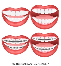 Vector image of mouth and teeth. Braces and bite correction. Dentistry and dental treatment concept. Element for your design of banners, posters, articles, etc.