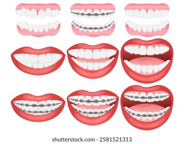 Vector image of mouth and teeth. Braces and bite correction. Dentistry and dental treatment concept. Element for your design of banners, posters, articles, etc.