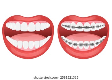 Vector image of mouth and teeth. Braces and bite correction. Dentistry and dental treatment concept. Element for your design of banners, posters, articles, etc.