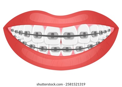 Vector image of mouth and teeth. Braces and bite correction. Dentistry and dental treatment concept. Element for your design of banners, posters, articles, etc.