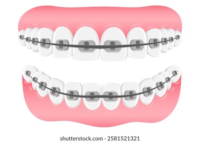 Vector image of mouth and teeth. Braces and bite correction. Dentistry and dental treatment concept. Element for your design of banners, posters, articles, etc.