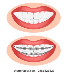 Vector image of mouth and teeth. Braces and bite correction. Dentistry and dental treatment concept. Element for your design of banners, posters, articles, etc.