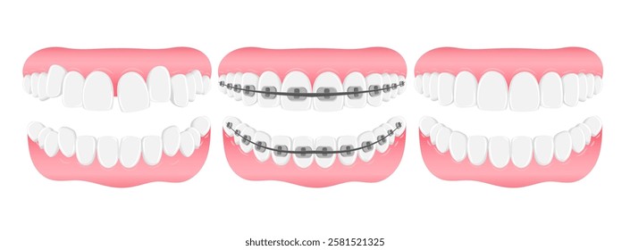 Vector image of mouth and teeth. Braces and bite correction. Dentistry and dental treatment concept. Element for your design of banners, posters, articles, etc.