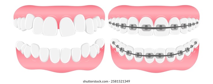 Vector image of mouth and teeth. Braces and bite correction. Dentistry and dental treatment concept. Element for your design of banners, posters, articles, etc.