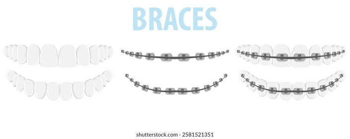 Vector image of mouth and teeth. Braces and bite correction. Dentistry and dental treatment concept. Element for your design of banners, posters, articles, etc.