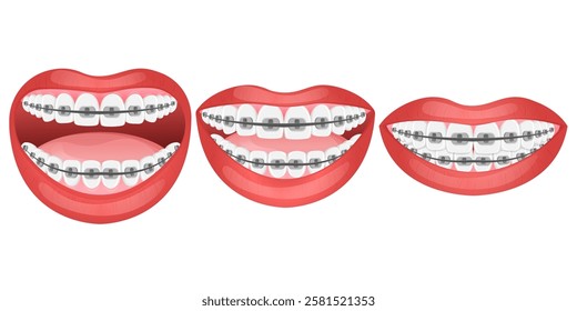 Vector image of mouth and teeth. Braces and bite correction. Dentistry and dental treatment concept. Element for your design of banners, posters, articles, etc.