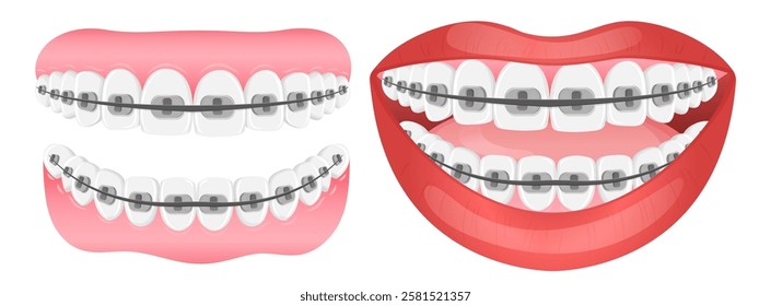 Vector image of mouth and teeth. Braces and bite correction. Dentistry and dental treatment concept. Element for your design of banners, posters, articles, etc.