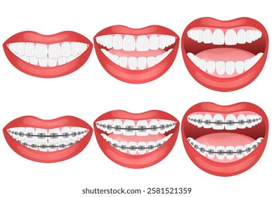 Vector image of mouth and teeth. Braces and bite correction. Dentistry and dental treatment concept. Element for your design of banners, posters, articles, etc.