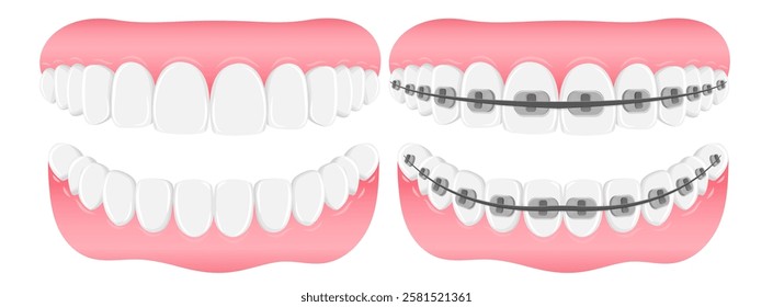 Vector image of mouth and teeth. Braces and bite correction. Dentistry and dental treatment concept. Element for your design of banners, posters, articles, etc.