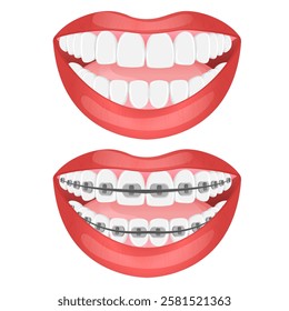 Vector image of mouth and teeth. Braces and bite correction. Dentistry and dental treatment concept. Element for your design of banners, posters, articles, etc.