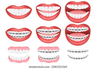 Vector image of mouth and teeth. Braces and bite correction. Dentistry and dental treatment concept. Element for your design of banners, posters, articles, etc.