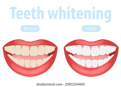 Vector image of mouth and teeth. Teeth whitening. Dentistry and dental treatment concept. Element for your design of banners, posters, articles, etc.