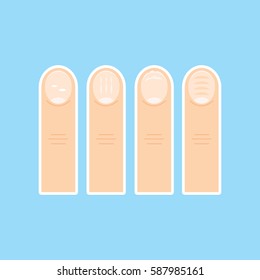 Vector image of nail diseases. 