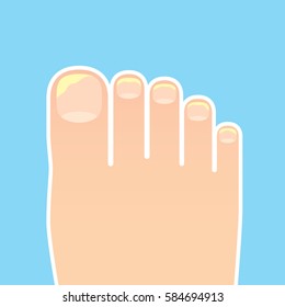 Vector image of nail fungus on foot.