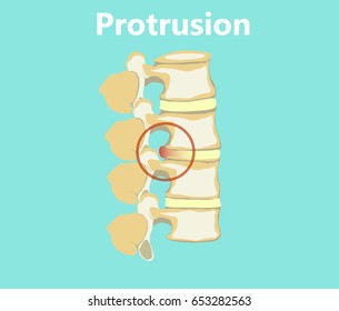 Vector image of protrusion of the spinal disc of the lumbar spine. The medical illustration is designed in a flat style. Picture of a sore disk. Side view.