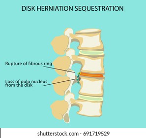 Vector image of sequestered herniated intervertebral disc. Rupture of the fibrous ring with complete prolapse of the pulpous nucleus in the spinal canal. The image is represented in a flat style.