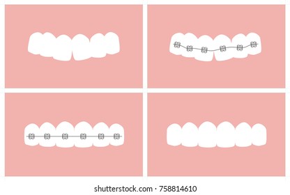  Vector image of the stages of orthodontic treatment (braces on teeth)