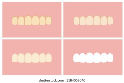 Vector image of the stages of teeth whitening
