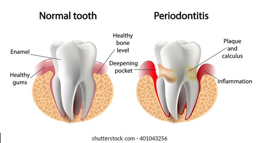 vector image tooth    disease