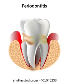 vector image tooth  Periodontitis disease