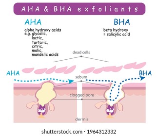 Vector info graphic shows difference of exfoliants. Scheme compare how AHA and BHA acids work with dead cells sebum lipid layer. Clogged pore inflammation peeling scientific anatomy poster. Clean skin