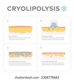 Vector infographic of the cryolipolysis process.
Layers of skin and tissues, before and after fat freezing treatment.
Graphic design illustration of fat freezing and reduction of fat cells.
