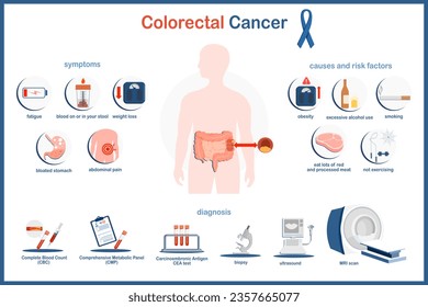 Vector infographic illustration of colon cancer. Medical illustration concept. Colon cancer symptoms, causes and Risk factors  and diagnosis of bowel cancer.flat style isolated on white background.