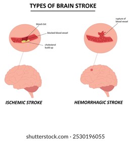 Infografía de Vector del accidente cerebrovascular isquémico y hemorrágico