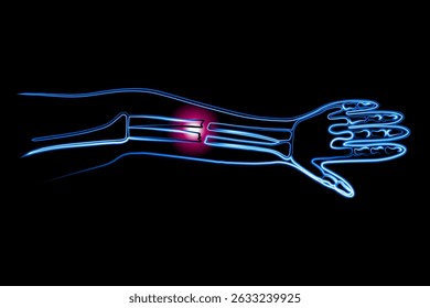Vector isolated illustration of a closed forearm fracture. Outline drawing of a hand fracture. X-ray of the hand.	