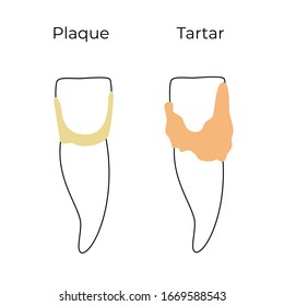 Vector isolated illustration of dental plaque stages. Tooth anatomy infographics. Medical banner or poster illustration.