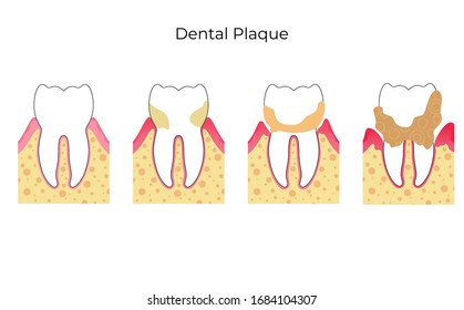 Vector isolated illustration of dental plaque stages. Tooth anatomy infographics. Medical banner or poster illustration.