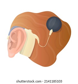 Vector isolated illustration with an ear and a hearing aid, where the sound processor is attached with a pin to the temporal bone. Concept of treatment of hearing loss, problems, otology.