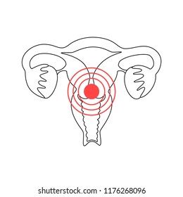 Vector Isolated Illustration Of Female Pain Reproductive System Anatomy. Uterus, Cervix, Ovary, Fallopian Tube Icon. Woman Medical Center, Hospital, Clinic, Diagnostic Logo. Internal Organ Symbol  