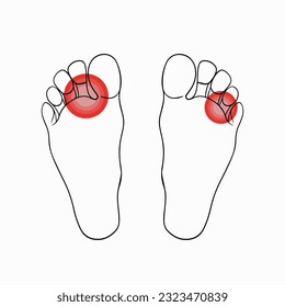 Vector isolated illustration of foot fungus. Contour drawing of foot fungus. Foot hygiene. Discomfort, itching of the fungus.