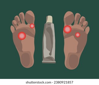 Vector isolated illustration of foot fungus. Fungal ointment.