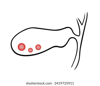 Vector isolated illustration of gall bladder.Gallstones.	
