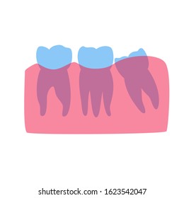 Vector isolated illustration of human wisdom tooth mesial impaction anatomy. Human jaws model with molar teeth row. Dentistry and dental surgery concept. Flat vector illustration on white