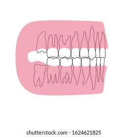 Vector isolated illustration of human wisdom tooth in gum anatomy. Human jaws model with molar teeth row. Dentistry and dental surgery concept. Flat vector illustration on white