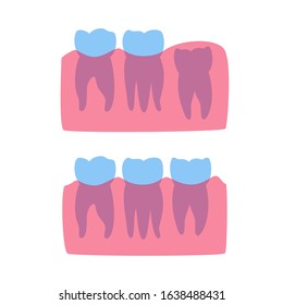 Vector isolated illustration of human wisdom tooth in gum anatomy. Human jaws model with molar teeth row. Dentistry and dental surgery concept. Flat vector illustration on white