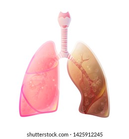 Vector isolated illustration of lung anatomy with cancer tumor. Human respiratory system icon. Healthcare medical center, surgery, hospital, clinic logo. Internal donor organ symbol poster