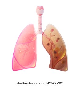 Vector isolated illustration of lung anatomy with cancer tumor. Human respiratory system icon. Healthcare medical center, surgery, hospital, clinic logo. Internal donor organ symbol poster