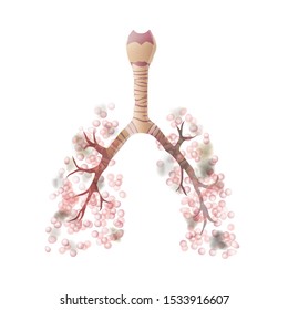 Vector isolated illustration of lung anatomy with cancer tumor. Human respiratory system icon. Healthcare medical center, surgery, hospital, clinic logo. Internal donor organ symbol poster